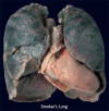 smokers-lung-22312.jpg 10.19 KB