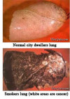 smokers_lung.jpg 11.79 KB